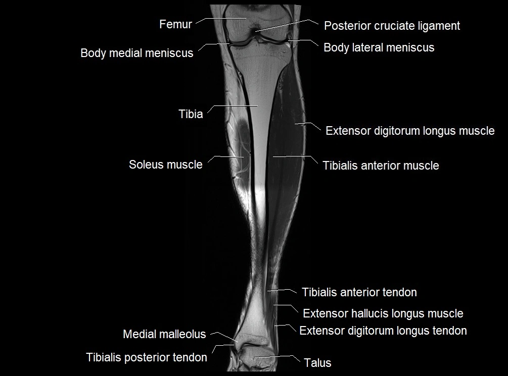 MRI 3T leg (tibia & fibula) labelled coronal cross sectional anatomy image 12.webp